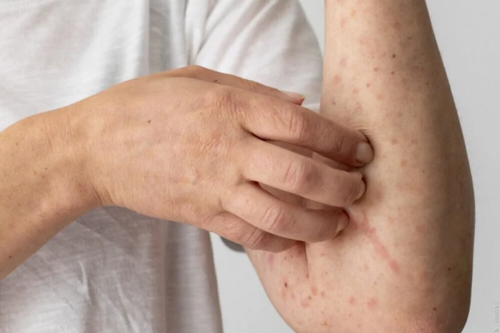 Шимолий Лондонда қизамиқ эпидемияси авж олмоқда