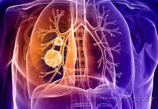 Ўпка саратони эркакларда кўпроқ учрайдими ёки аёлларда?