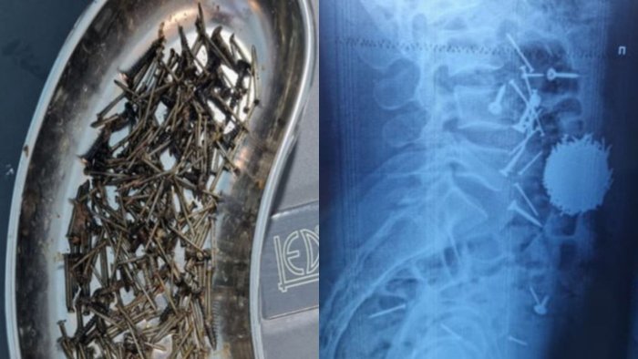 Samarqandda bemorning qornidan 200 gramm mix olib tashlandi