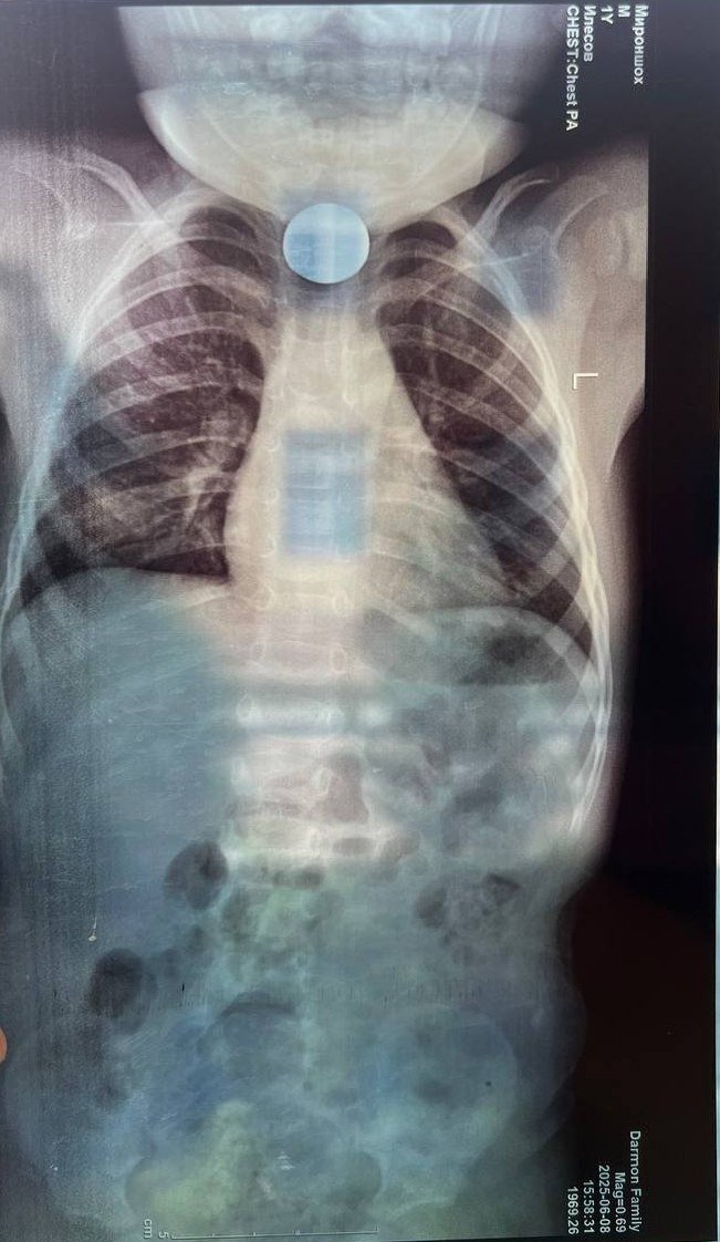 Buxoroda 2 yoshli bolaning tomog‘idan ikkita tanga chiqarib olindi