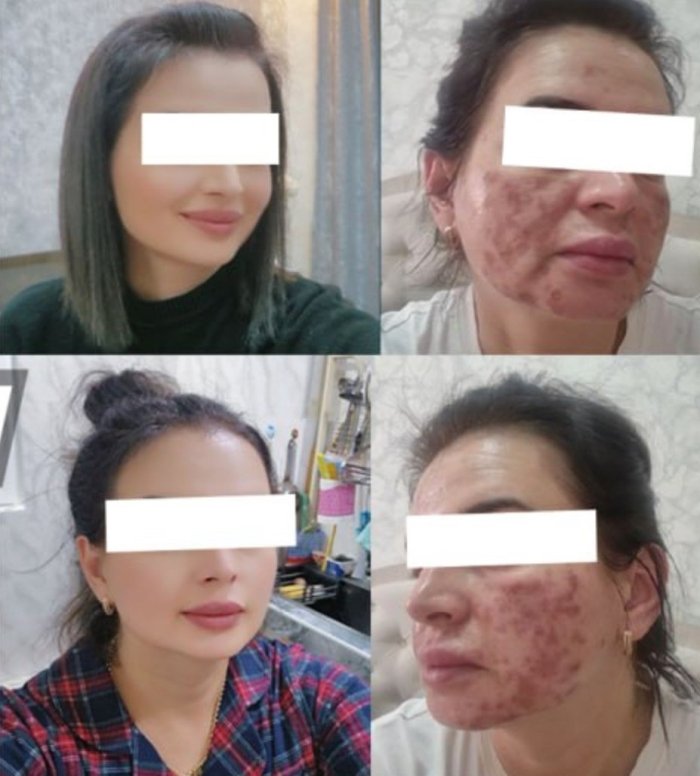 Go‘zallik salonida tibbiy bilimsiz xodim ayolning yuzini 80% kuydirib yubordi