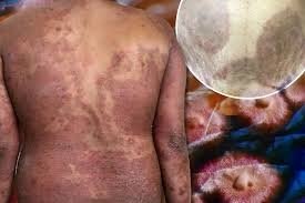 Европада хавфли инфекция тарқалмоқда