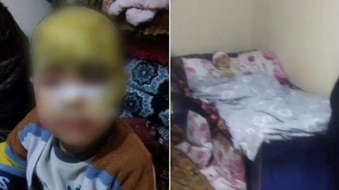 Қашқадарёда тарбиячи бехосдан қайнаган сувни боланинг пешонасига тўкиб юборди