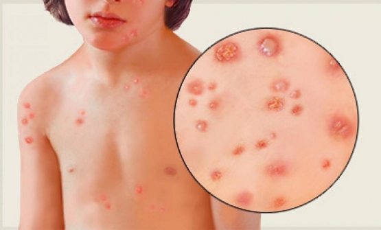 ЖССТ Ўзбекистонни қизамиқдан холи давлатлар рўйхатидан чиқарди