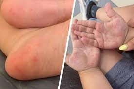 Yurtimizda bolalar orasida Koksaki virusi avj olayotgani haqidagi xabarlar asossiz!